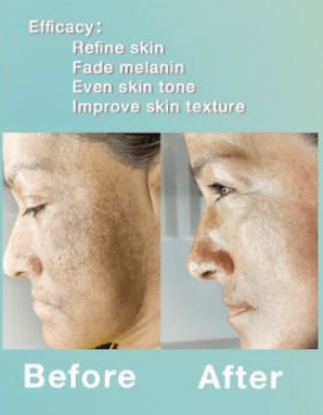 SQT Bio Microneedling Revitalizing Beauty Set - 4 treatments